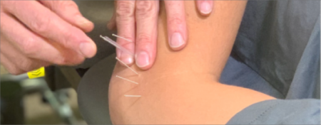 dry needling Tempe, Arizona