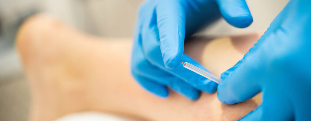 Dry needling therapy in Arizona