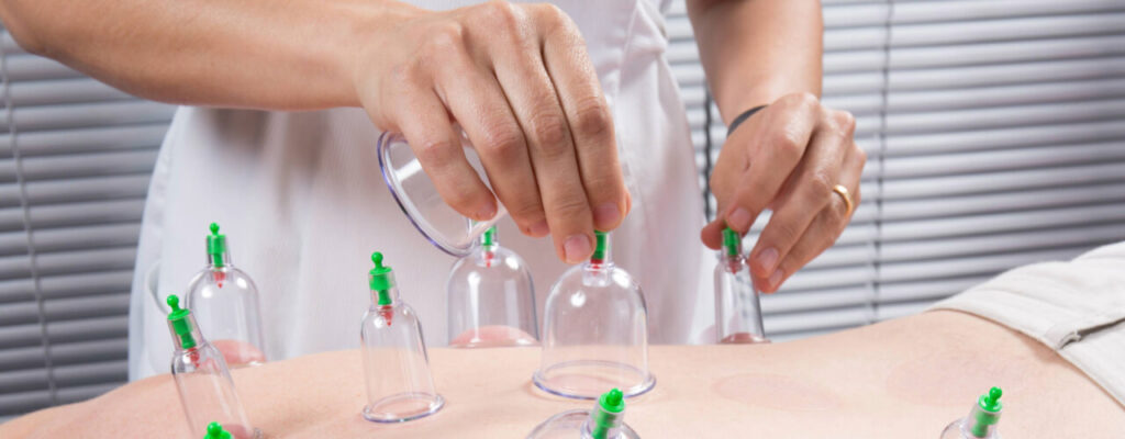 cupping therapy in Arizona by Orthopedic Sports Therapy