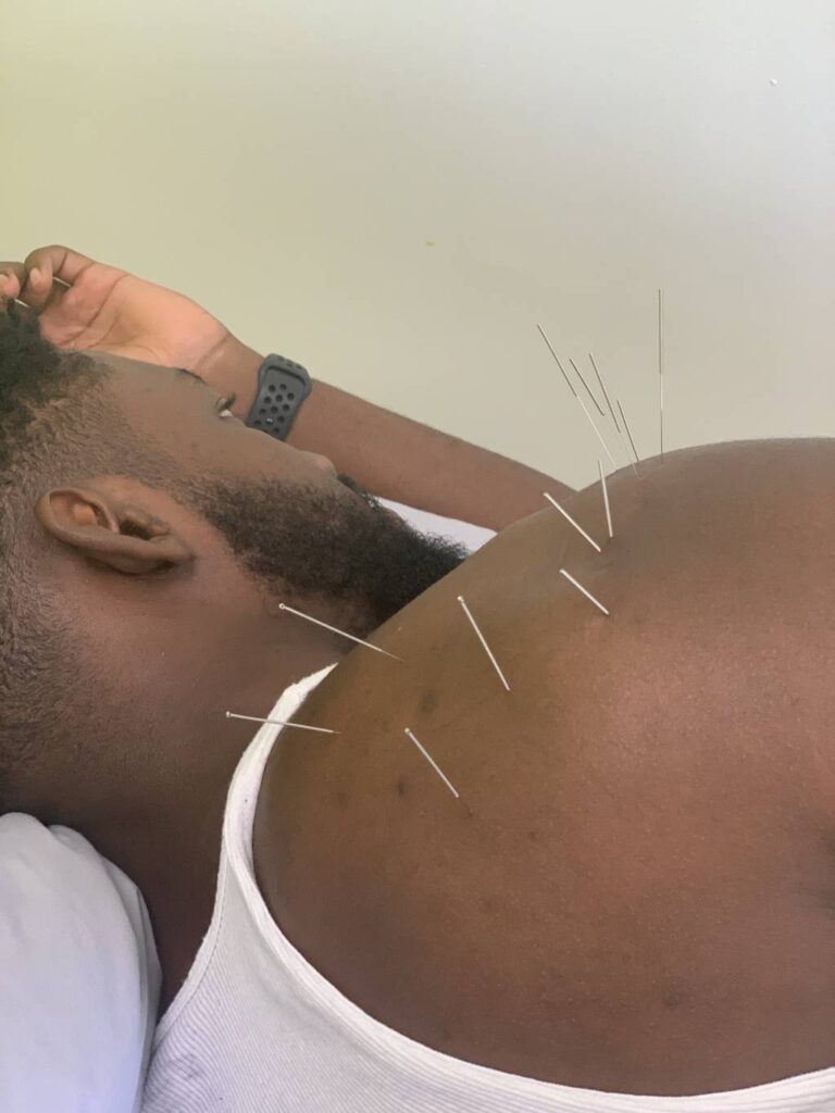 Have You Ever Heard of Dry Needling For Pain Relief?
