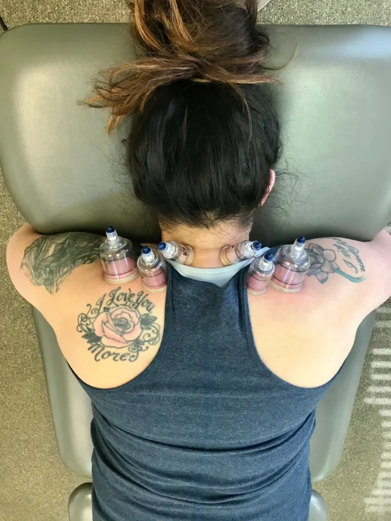 Cupping Treatment Could Help You Find Lasting Pain Relief